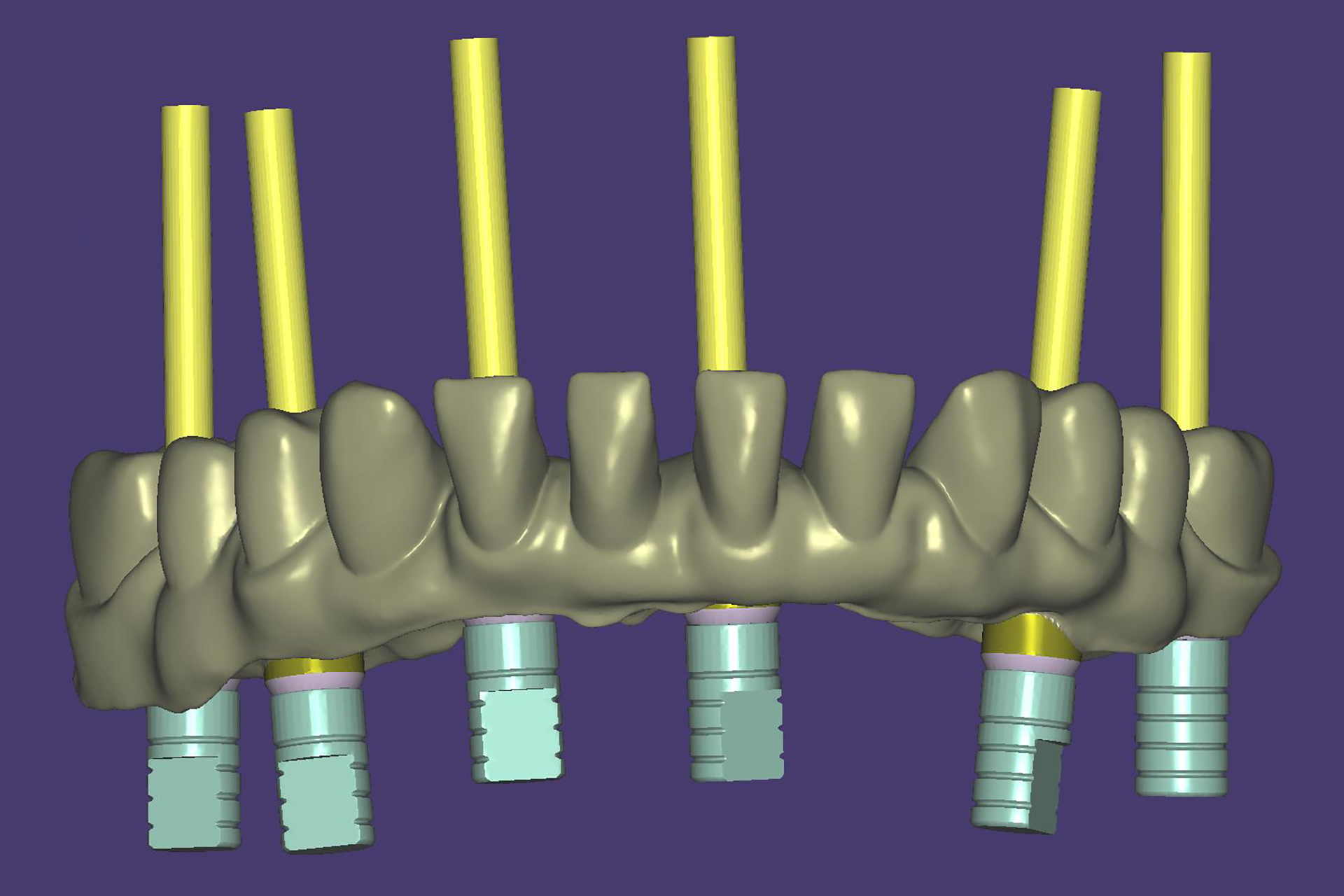 CAD/CAM