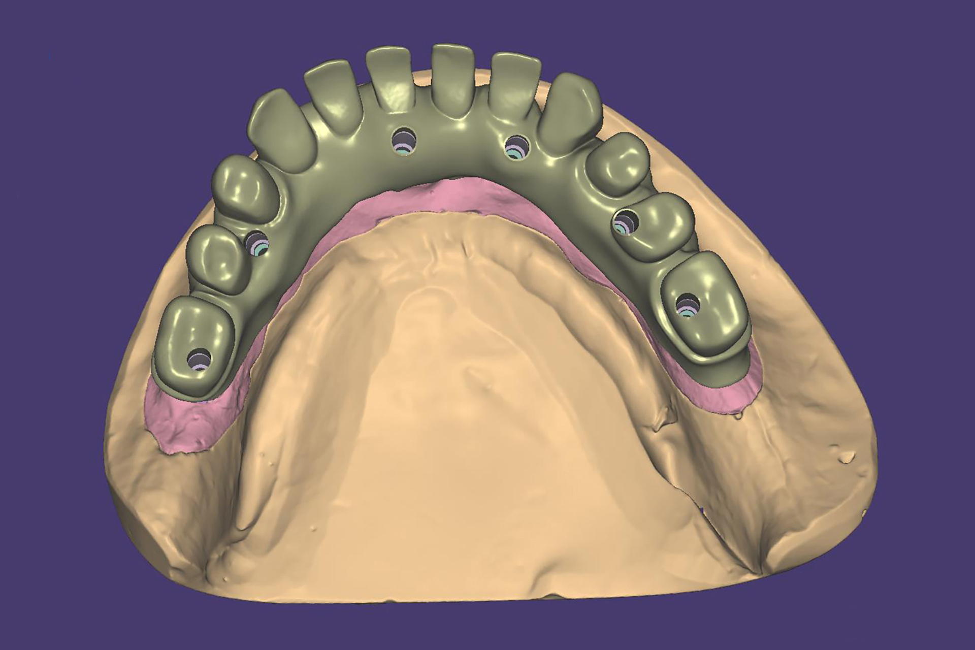 CAD/CAM